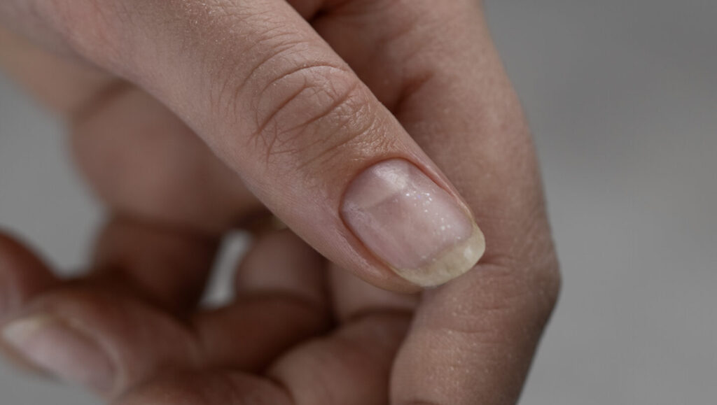 De natuurlijke nagel van de duim na het verwijderen van het oude kunstproduct